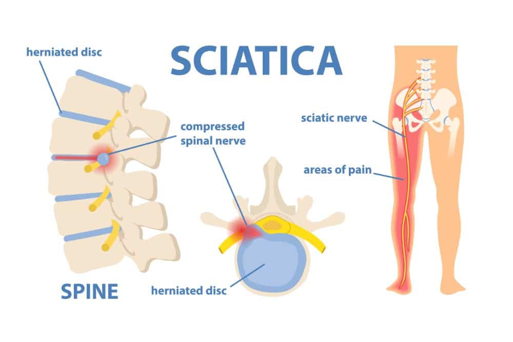 Picture explaining what the sciatia is and where it is in the human body used to answer the question Is SUP Good for your Sciatia